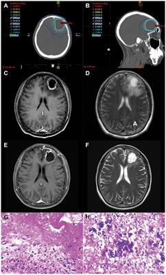 Bevacizumab reduces cerebral radiation necrosis due to stereotactic radiotherapy in non-small cell lung cancer patients with brain metastases: an inverse probability of treatment weighting analysis